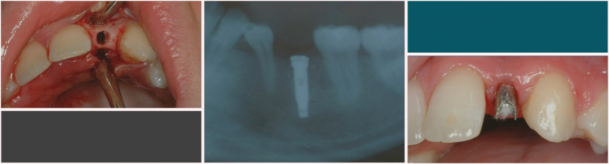implant
