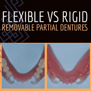 Flexible vs. Rigid Removable Partial Dentures - V2538 - CE Video Library