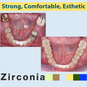 Strong, Comfortable, Esthetic Rehabilitations with Zirconia - V1942