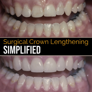 Surgical Crown Lengthening Simplified - S4351 - Periodontics - CE Video Library