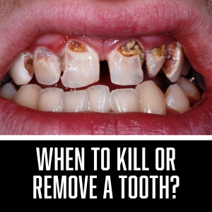 When to Kill or Remove a Tooth? - S1352 - Endodontics - CE Video Library