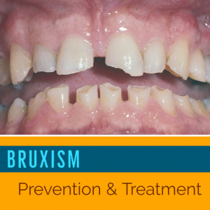 Bruxism - Prevention and Treatment