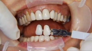 Complex Oral Rehabilitation - V1934 - CE Video Library