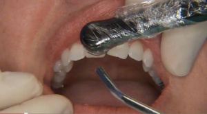 Direct Resin Veneers - A Great Practice Builder! - V1559 - Esthetic Dentistry - CE Video Library