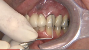 Easy Crown Lengthening - V4346 - Periodontics - CE Video Library