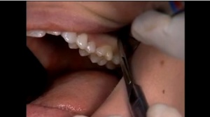 Easy Third-Molar Extractions - V4103 - Oral Surgery - CE Video Library