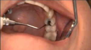 Minimally Invasive Periodontal Therapy - V4323 - CE Video Library