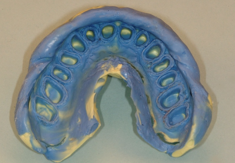 Predictable Fixed and Removable Prosthodontic Impressions V1931 CE