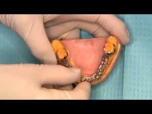 Predictable Removable Partial Dentures - V2551 - CE Video Library