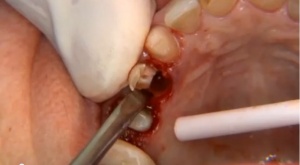 Socket Preservation and Bone Grafting - V4350 - Periodontics - CE Video Library