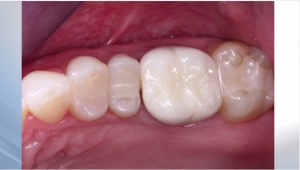 Onlays vs. Crowns - V1572 - Esthetic Dentistry - CE Video Library