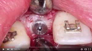 Simple, Inexpensive Implant Placement – Guide or No Guide? - V2373 - Implant Dentistry - CE Video Library