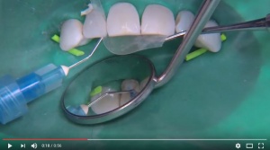 Mastering Frequent Esthetic Challenges with Resin - V3582 - Esthetic Dentistry - CE Video Library