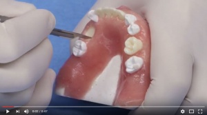 Atraumatic Removal of Teeth - Erupted and Impacted - V4181