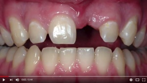 New Soft-Tissue Grafting Alternatives - Time to Change! - V4385 - Periodontics - CE Video Library