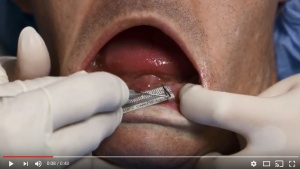 Simple, Inexpensive Implant Solutions for Edentulous Mandibles - V2388 - Implant Dentistry - CE Video Library