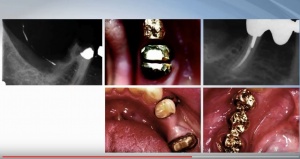 Apicoectomies, Frenectomies, Biopsies, Hemisections, and More! - V4189 - Oral Surgery - CE Video Library
