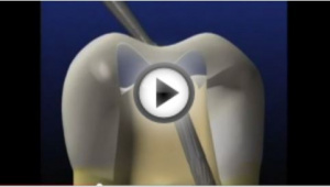 Nonsurgical Removal of: Posts &amp; Broken Instruments - V1333