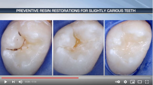Making Dental Caries Prevention a Win-Win Concept - V5120 - Preventive Dentistry - CE Video Library