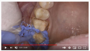 Impressions Can Be Simple &amp; Predictable - V1922 - Prosthodontics, Fixed - CE Video Library